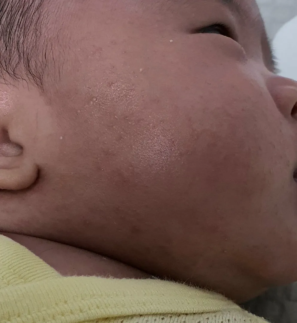 아기 피부트러블(사진첨부)