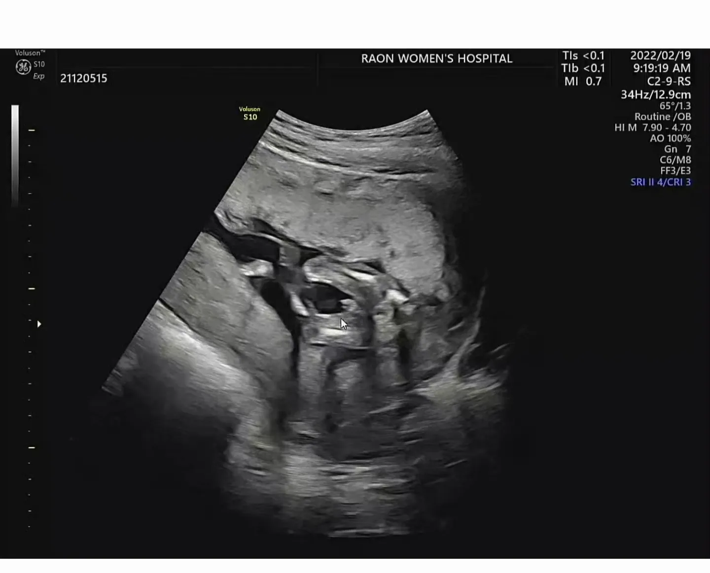 14주 6일, 성별 같이 확인해주세요:)