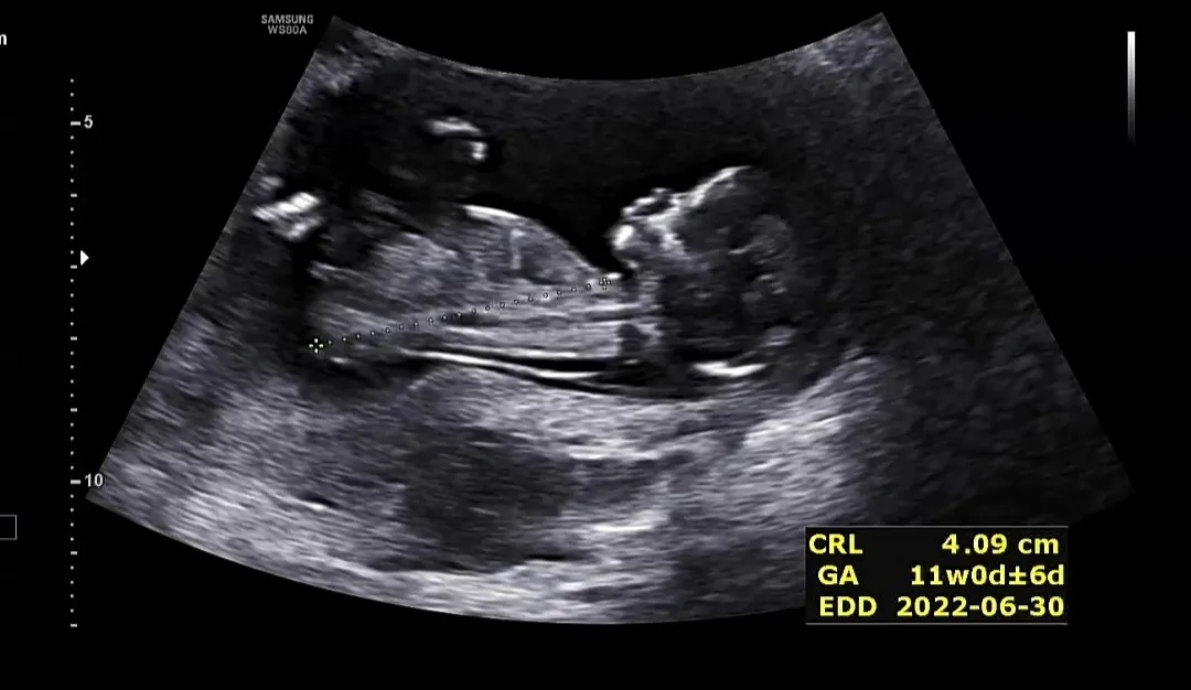 12주5일 각도법 성별 예측 가능할까용?