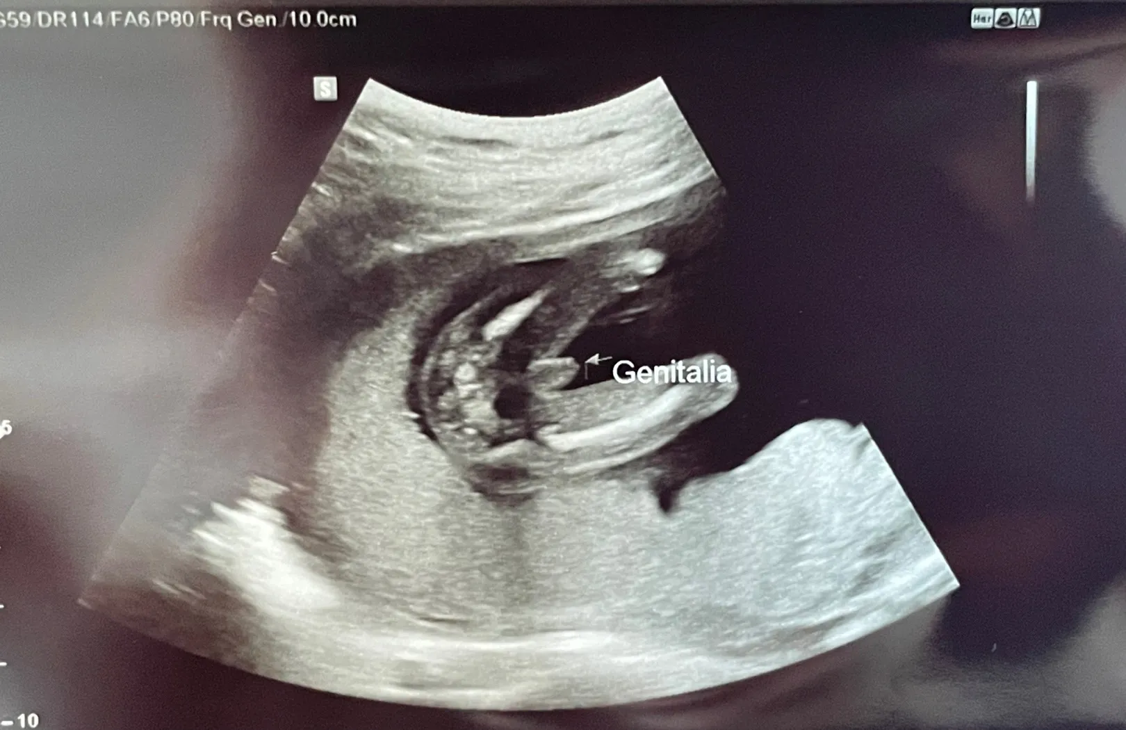 16w5d 빼박 성별 보고왔어요 ㅎㅎ