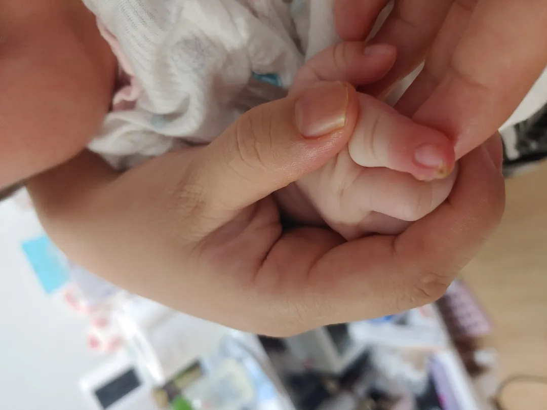 아기50일전 손톱깍다가 살점..그후 곪아서 하얗고파랗게되였는대