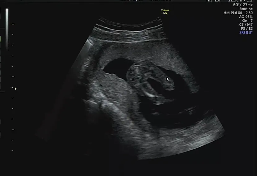 16w2d 초음파 함 봐주세요~