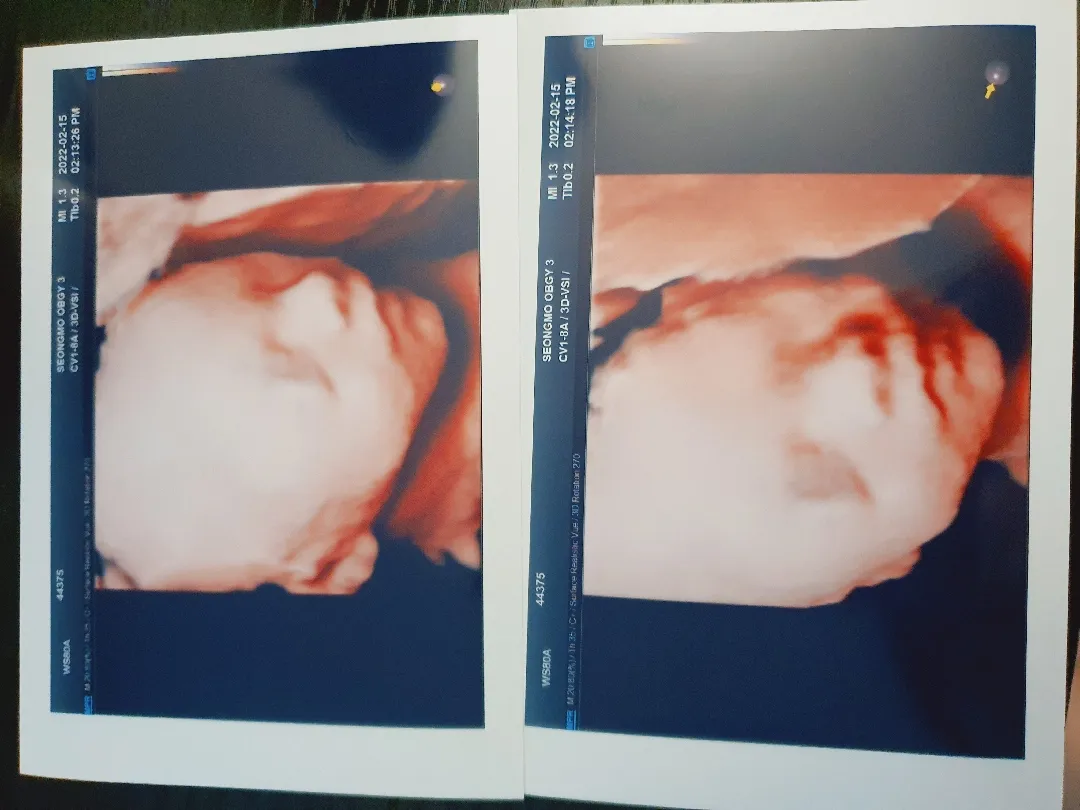 저희 아가도 입체초음파..☆