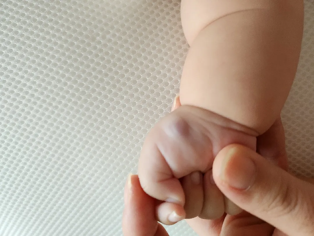 손에 멍.. 병원에 가봐야할까요?