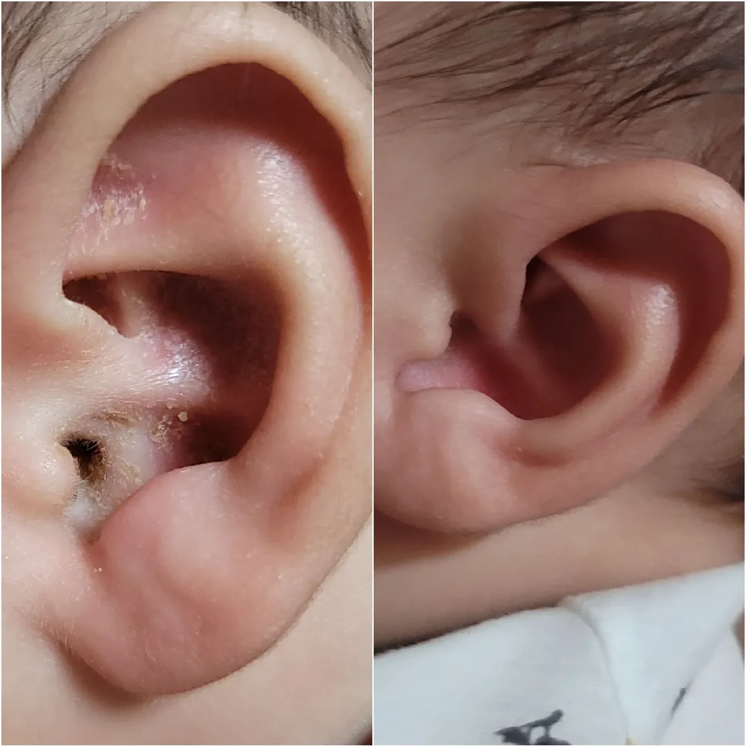 아기 귀 병원 후기입니다😊