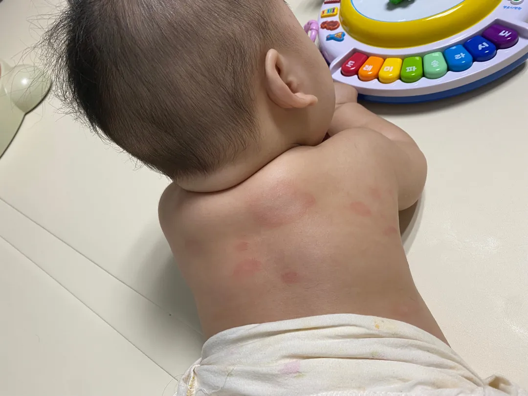 동전습진 어떻게 케어해주나요ㅠㅠ