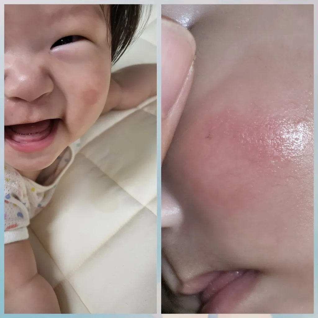 얼굴 습진??