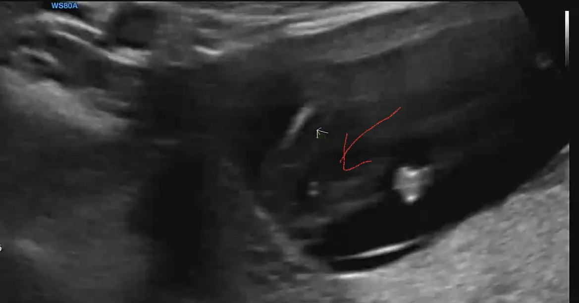 12주3일 이거 고추인가요????
