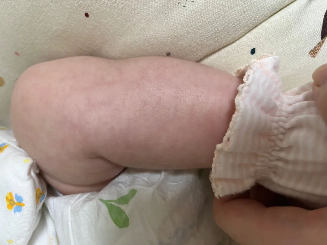 아기 피부 모공각화증일까요 ㅠ