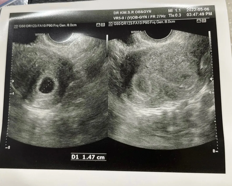 아기집 크기와 난황