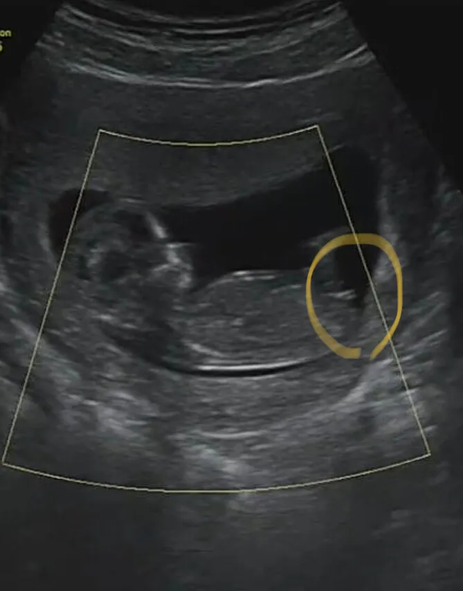 12주 3일) 이게 생식기일까요??