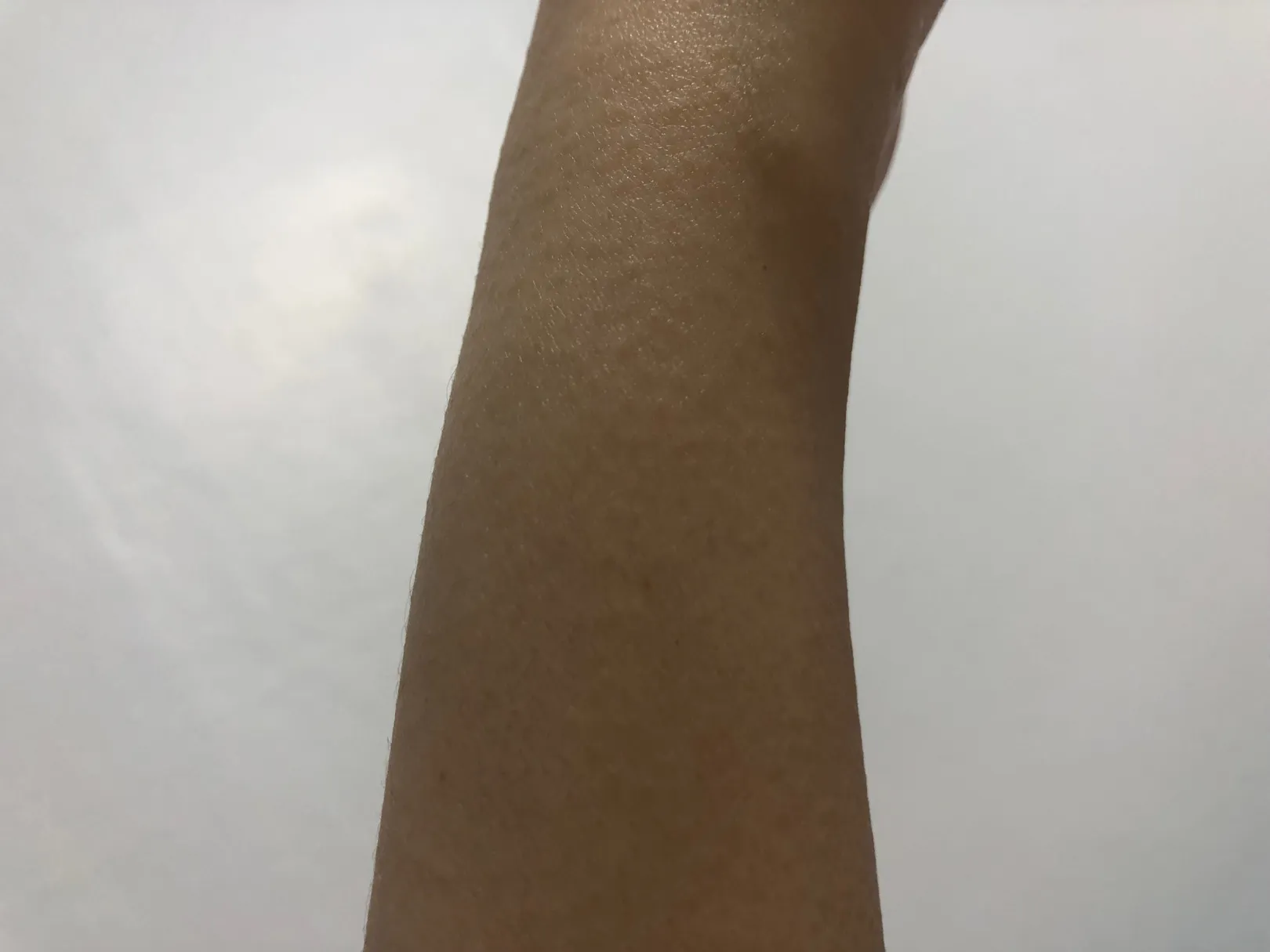 임산부 소양증 후 피부 돌아오나요?ㅠ(사진있음)