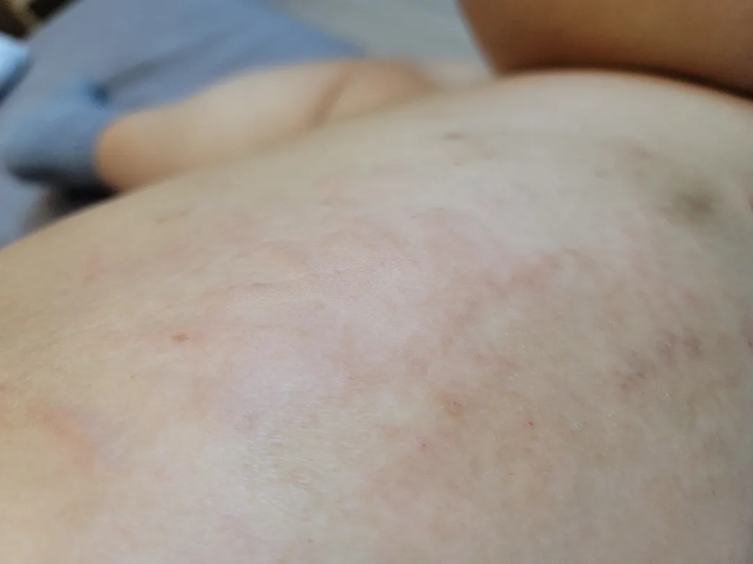 출산 후 소양증