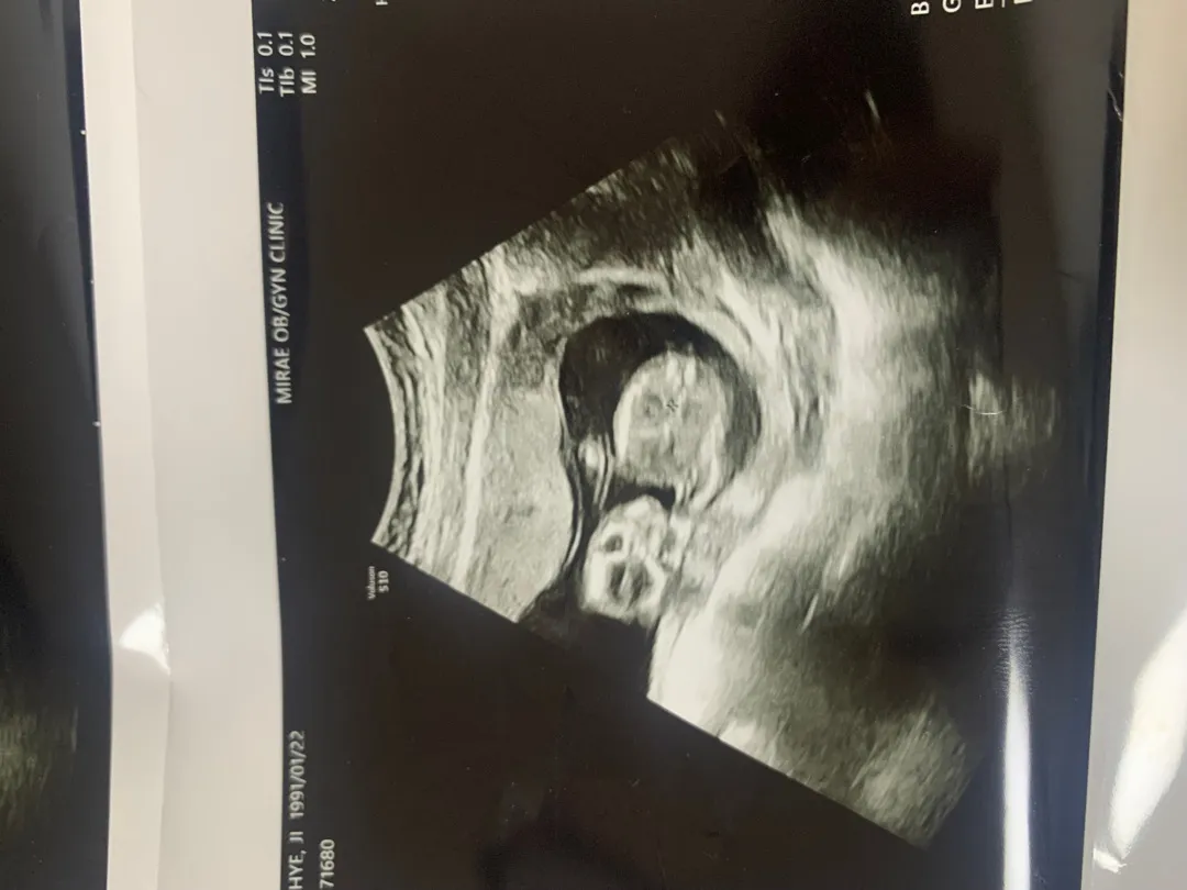 14주 4일차인데 아이 성별이 짐작이 안되네요ㅜㅜ 이 사진들로는 확인이 힘들겠죠??