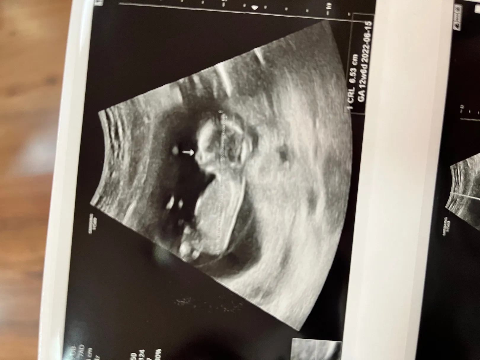 12주5일 성별 가능할까요?