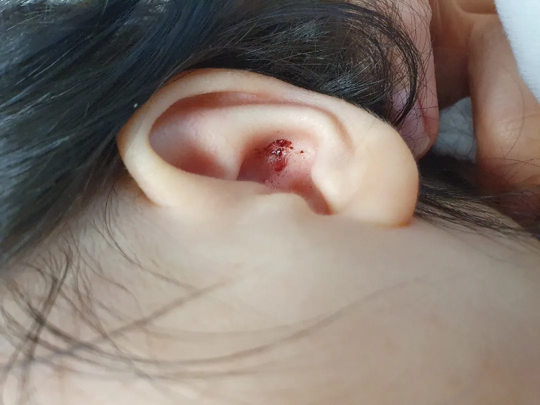 귀에 피딱지가ㅠ