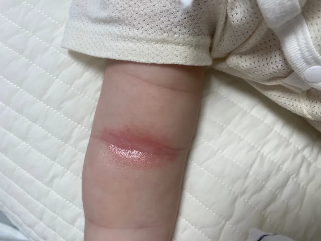 피부 ㅠㅠ