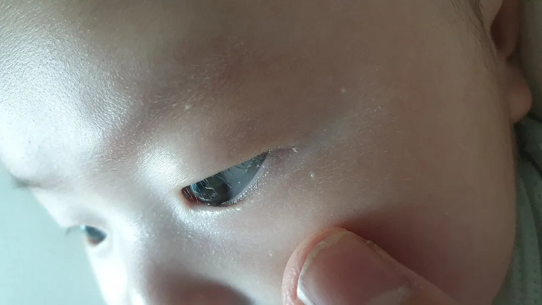 아기 눈 주변에 이런게 났는데 뭘까요?