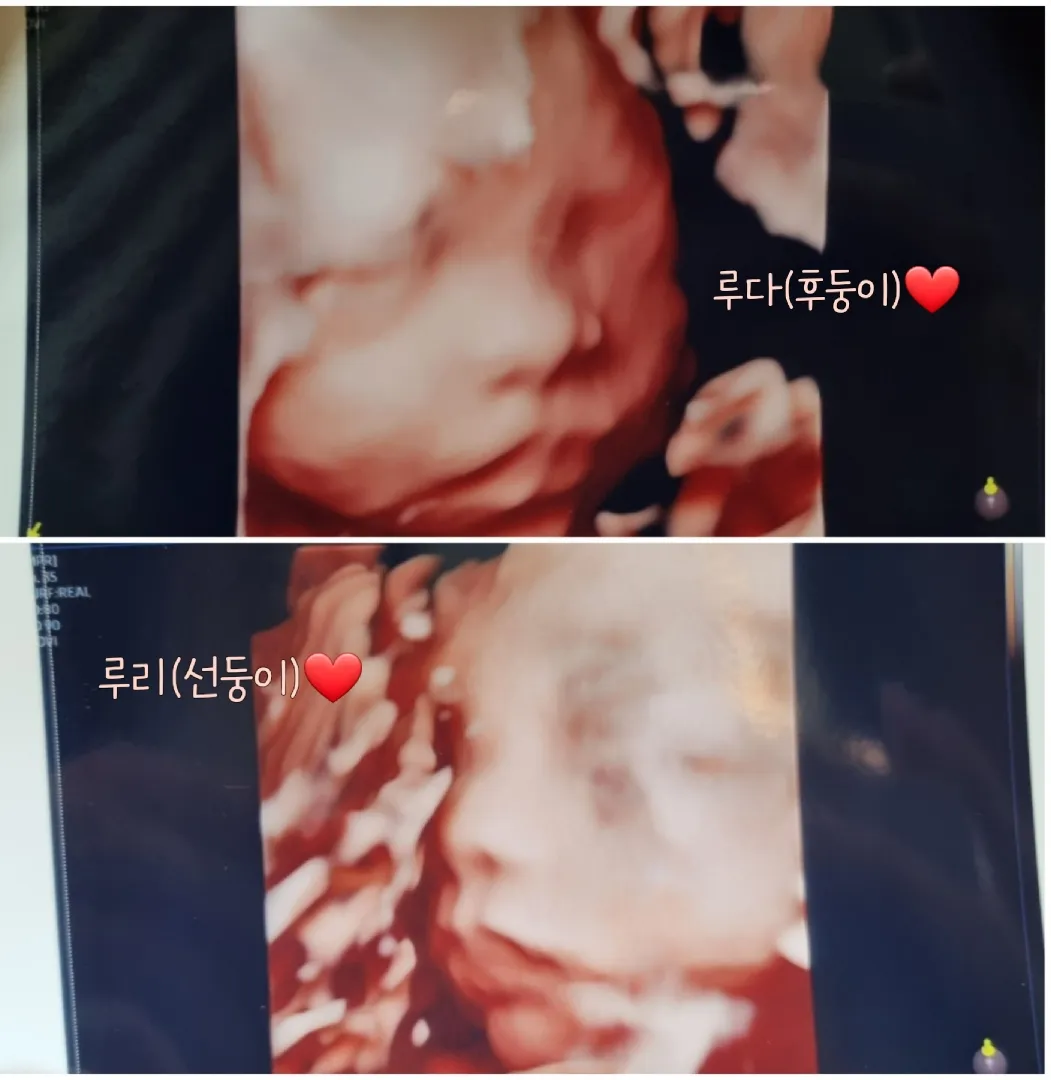 저도 입체 초음파...ㅎㅎ