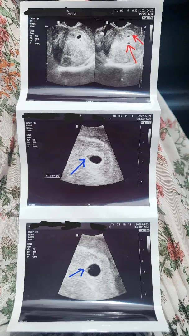 선근증이 심하고 난황도 못봤어요 ㅜㅜ 걱정돼요