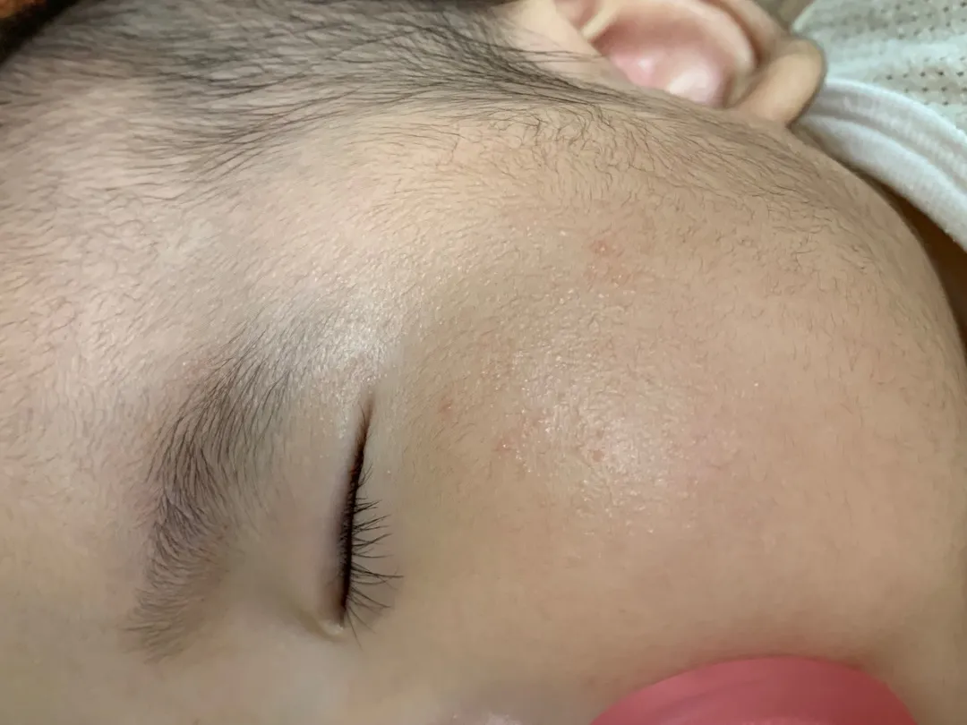 피부 ㅠ