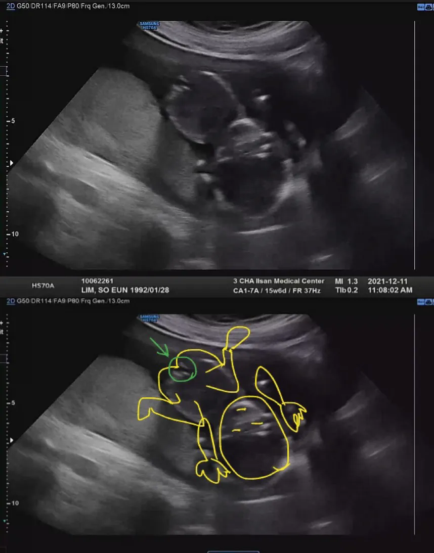 15w6d 양가 어머님들 슬퍼하실 소식이..ㅎ
