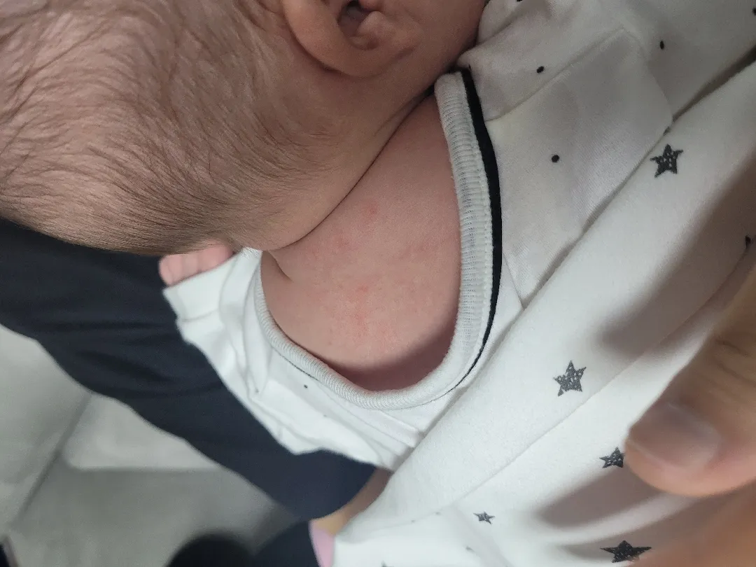태어난지 27일째된 아기...붉은반점