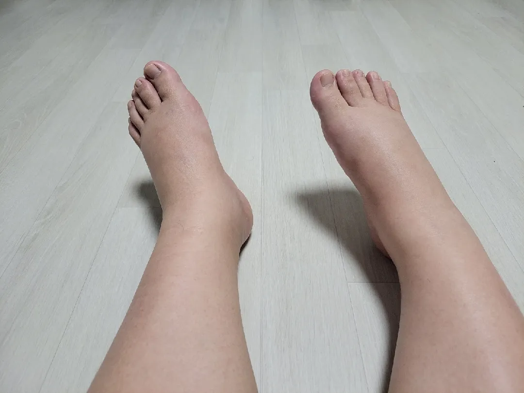 발붓기ㅜ 부종