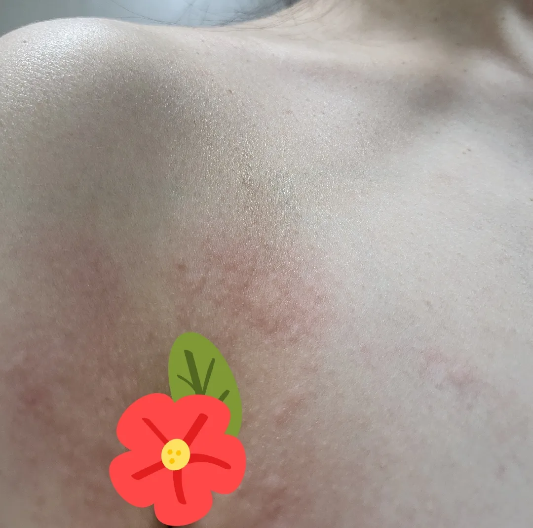 피부발진 좀 봐주세요 ㅠㅠ(사진주의)