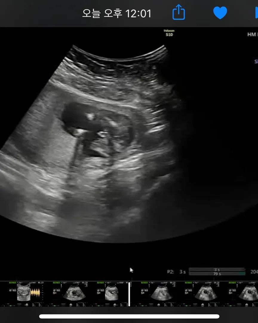 15주6일 성별확인했어요~