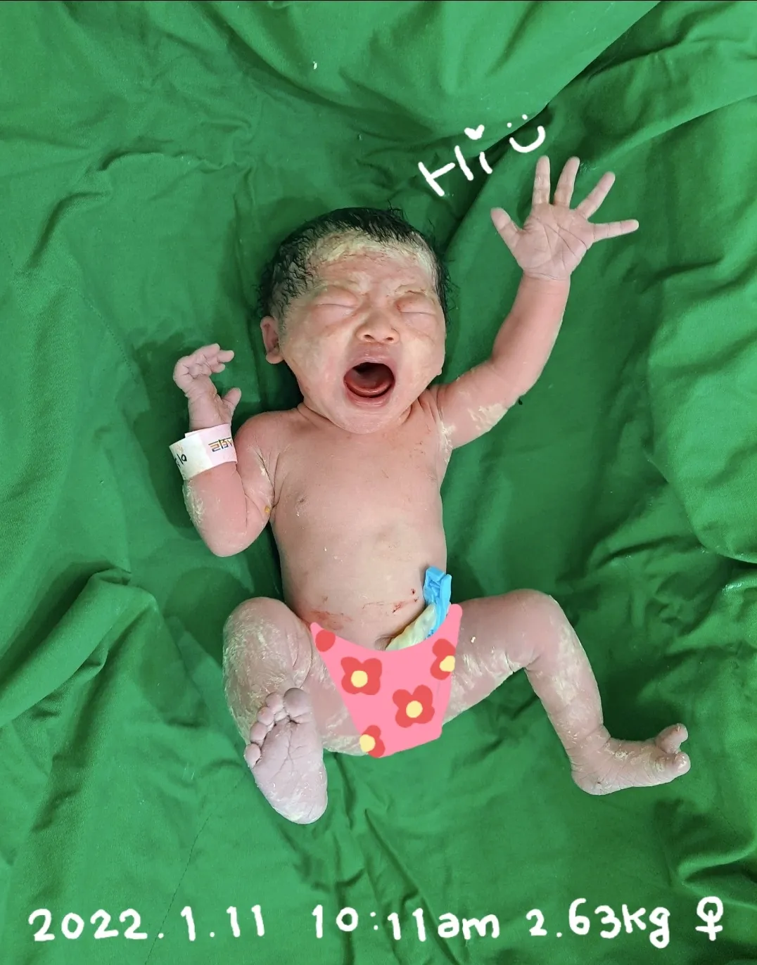 1월 11일 방뺐어요~👶 (제왕출산 후기)