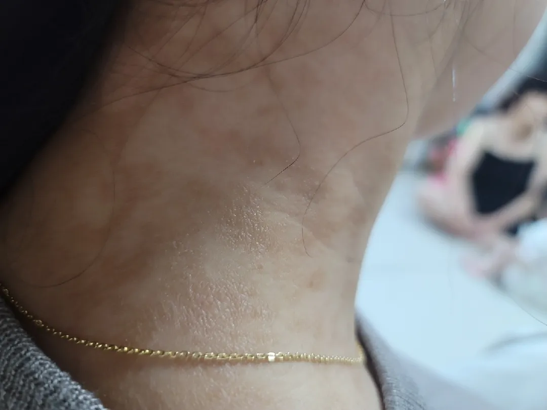 혹시 피부 저처럼 변하신분있나여ㅠㅠ