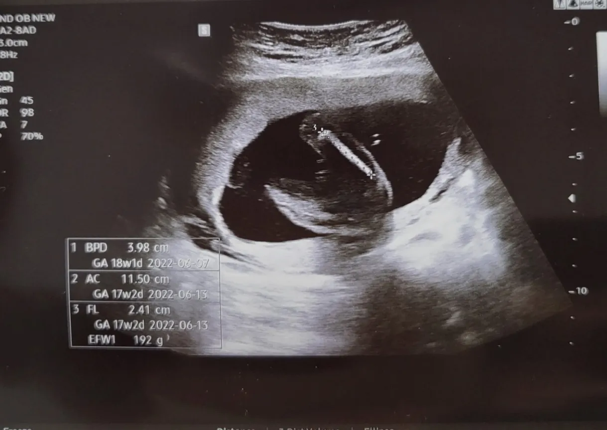 17w3d 성별 좀 봐쥬세요 !!