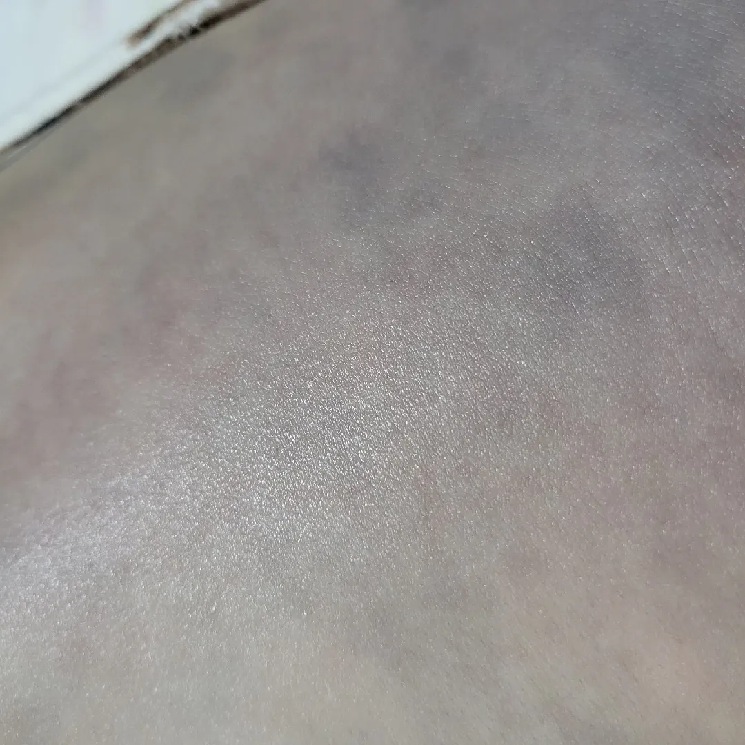 아기피부ㅠ