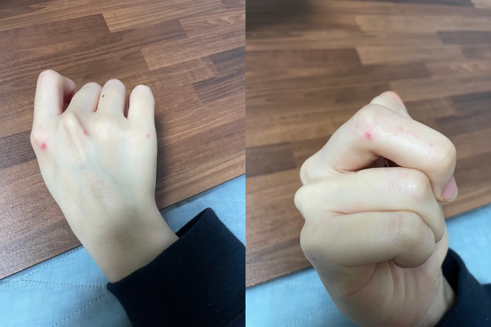 손가락이나 손등 붉은점
