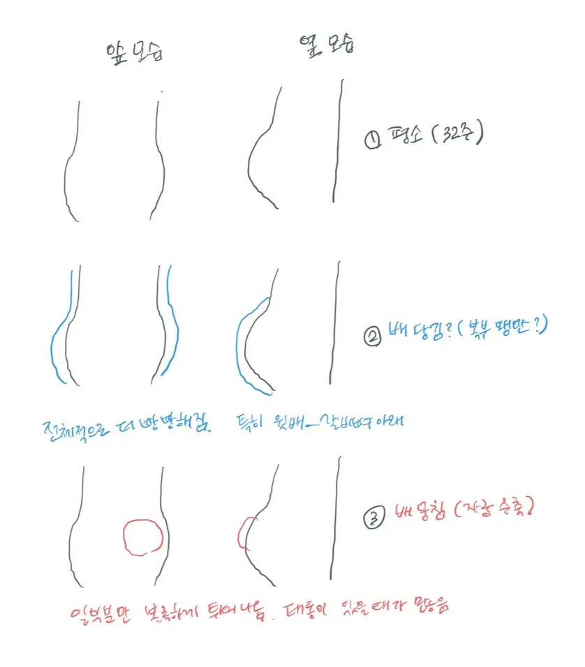 (32주) 배뭉침으로 입원한 경험담 공유해봅니다