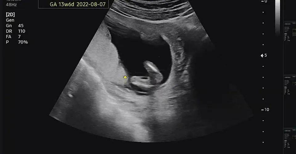 13주차 사진인데요 성별이 뭘로 보이실까요??