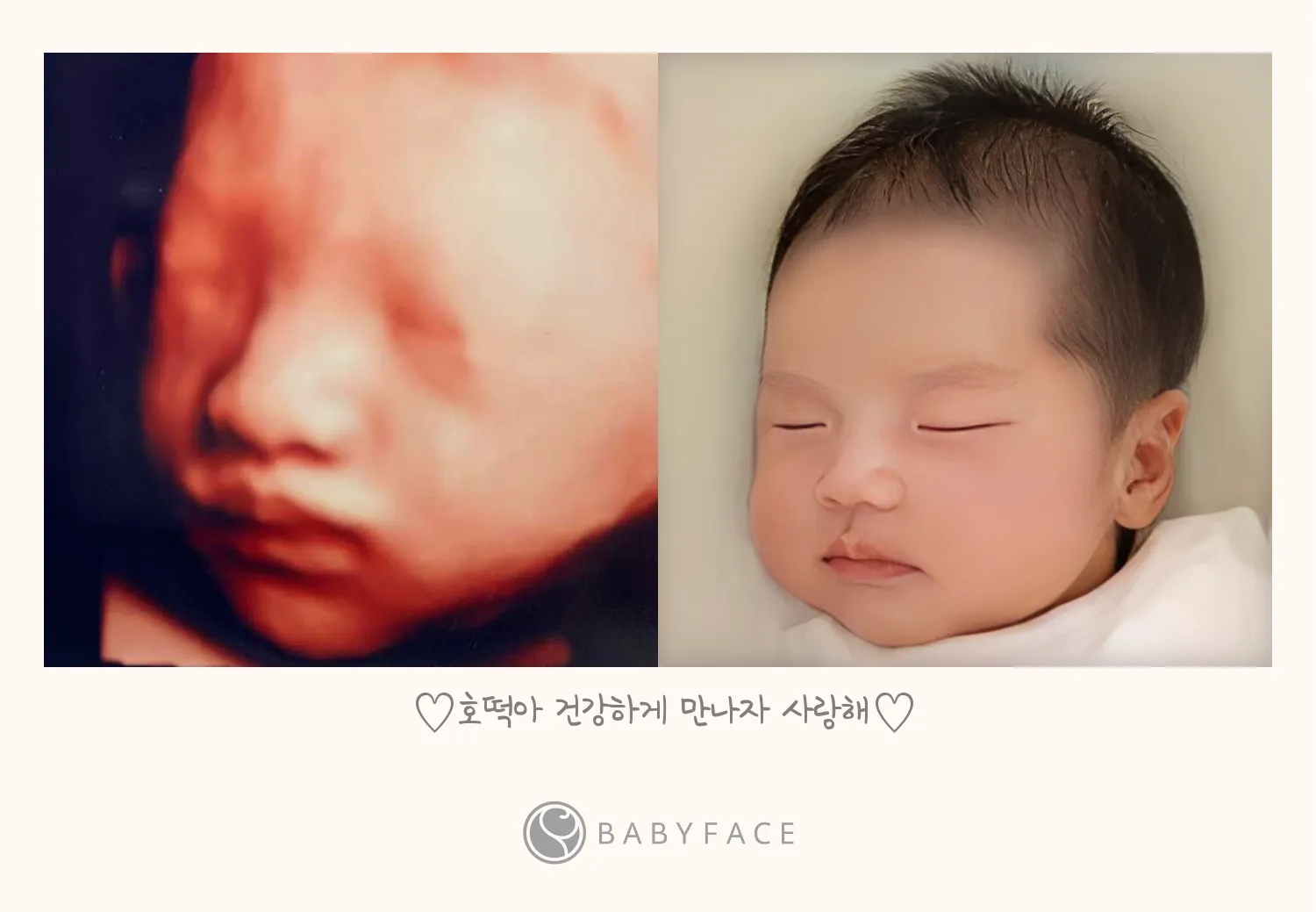 입체초음파+베이비페이스