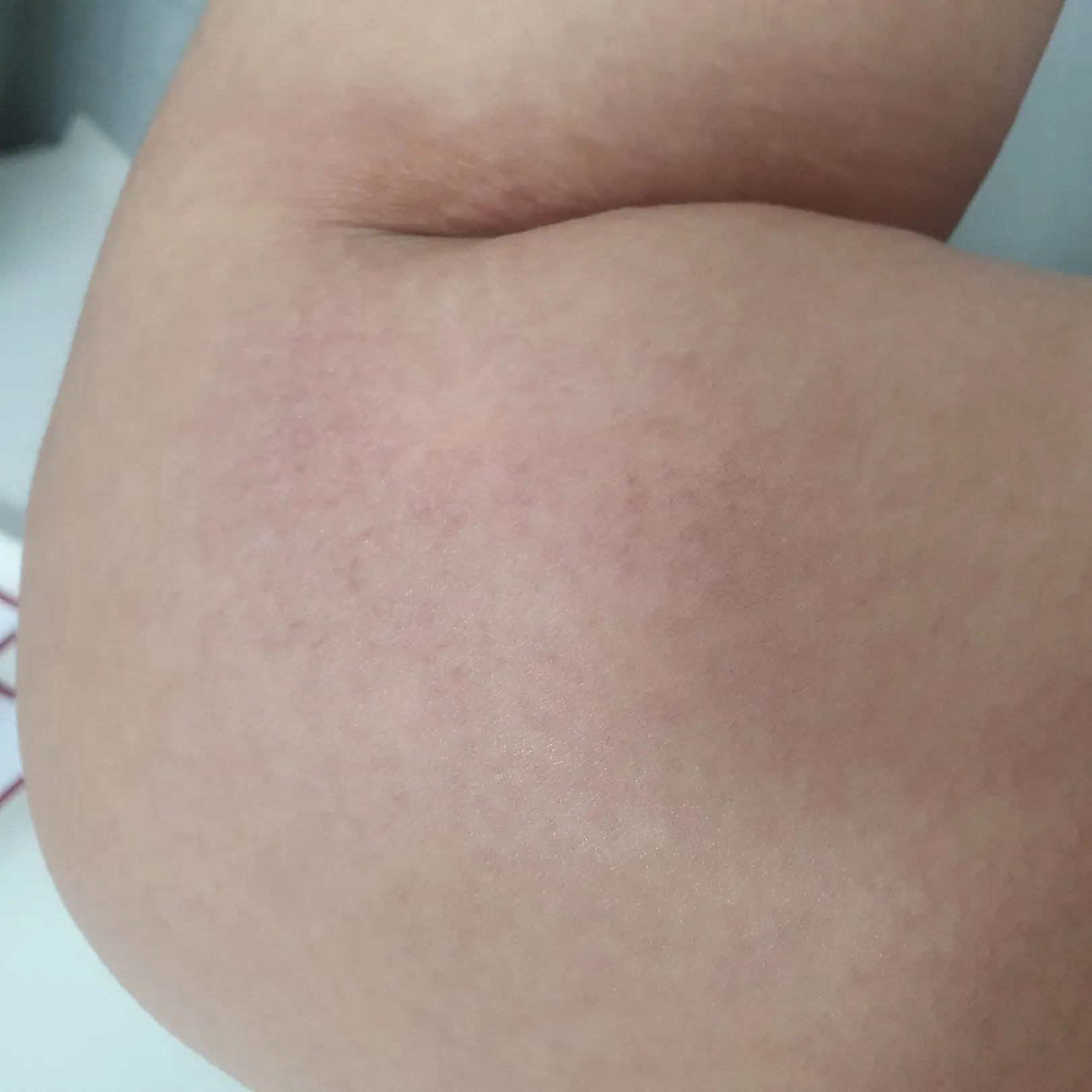 다리쪽 피부가..ㅠㅠ