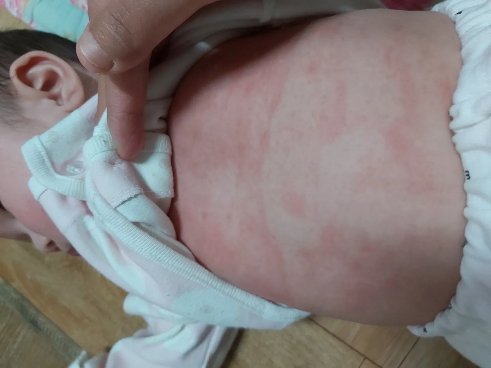 아기땀띠일까요?