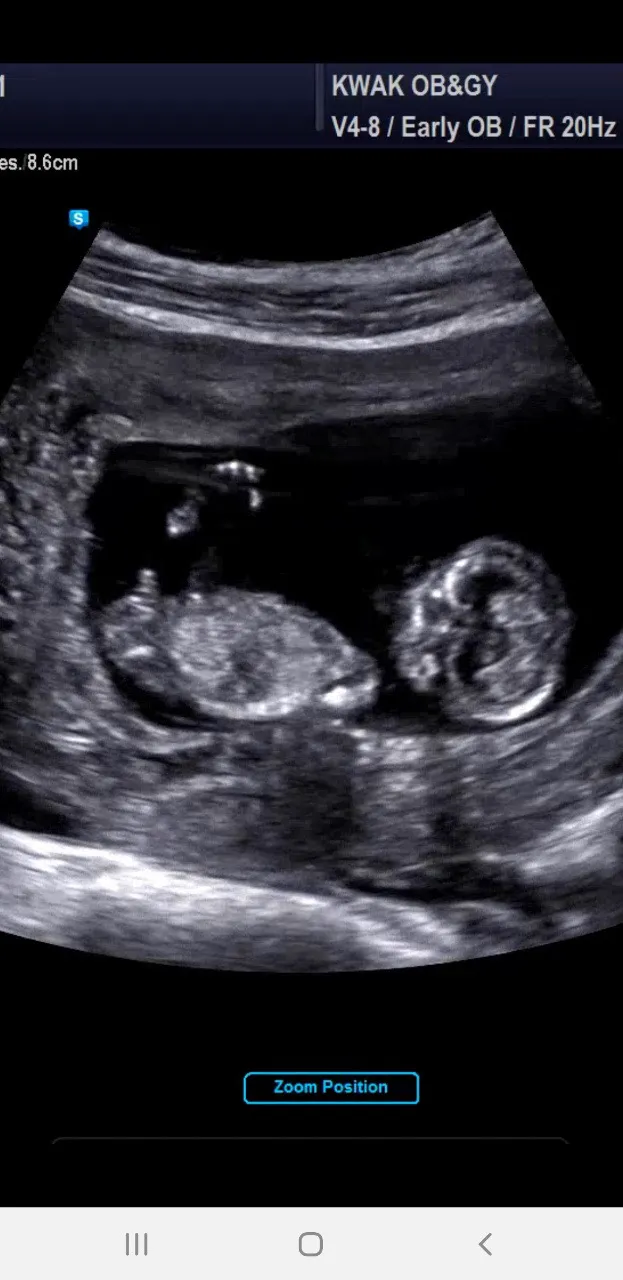 12주 초음파 아기 성별👶🏻