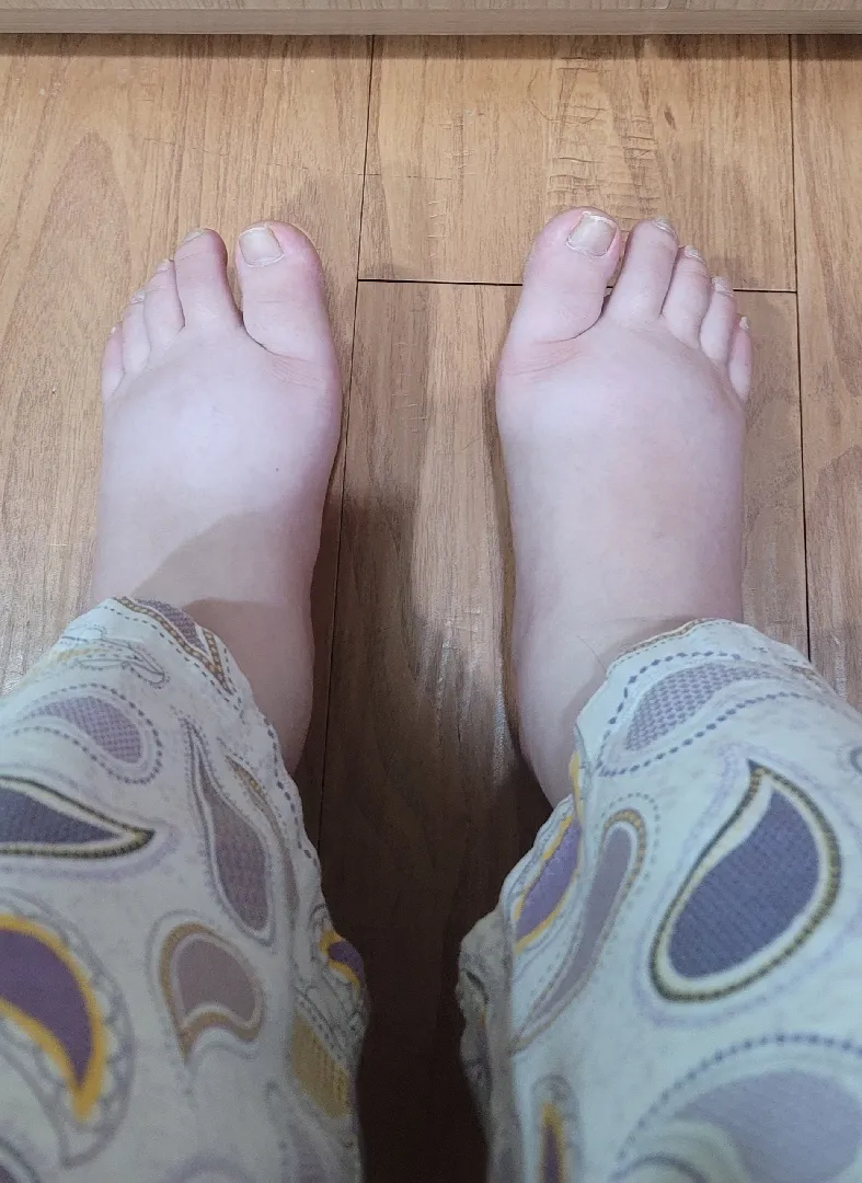 출산 후 심해진 붓기.