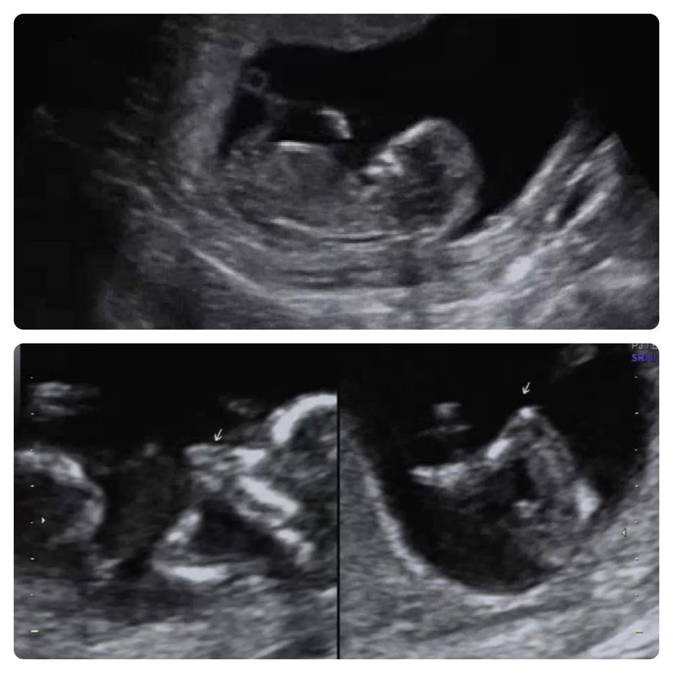 성별이 궁금해요!!~~~(12w2d)