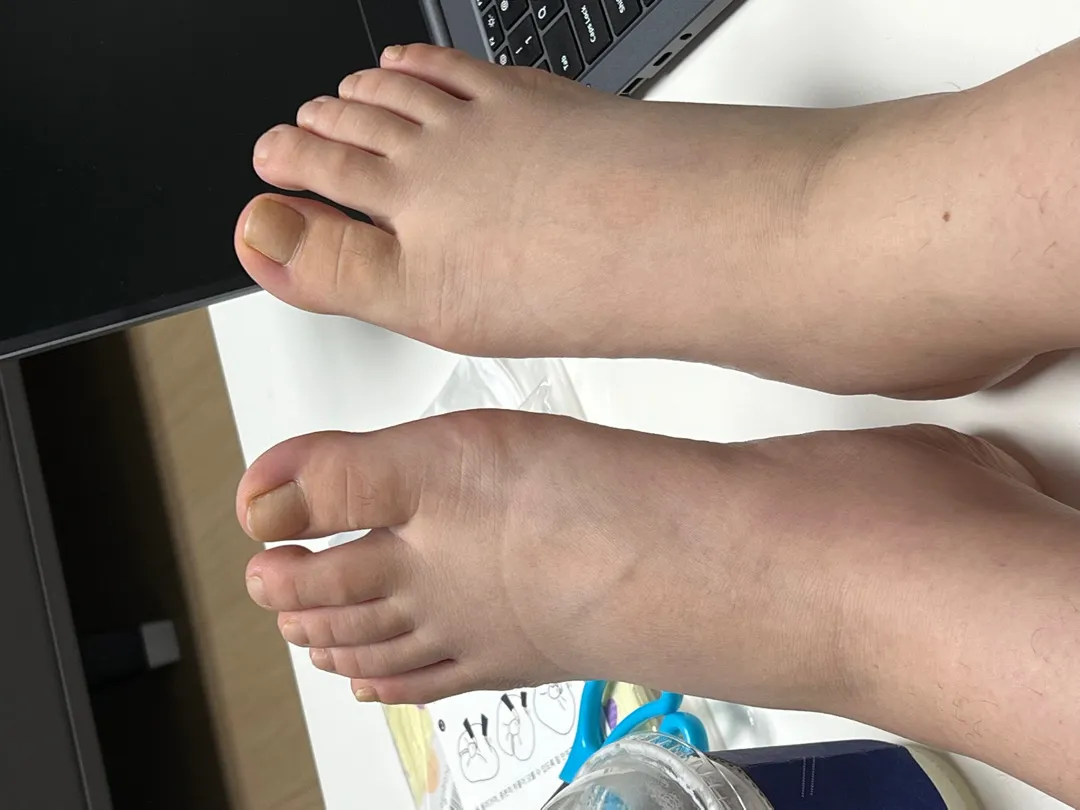 36주 다리 붓기 실환가요…?