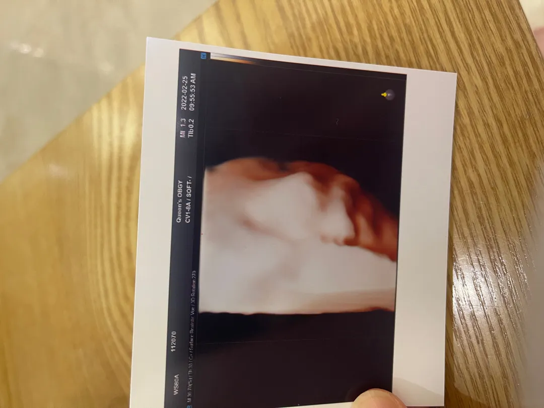 저도 입체 초음파 자랑해봐요 ㅎ