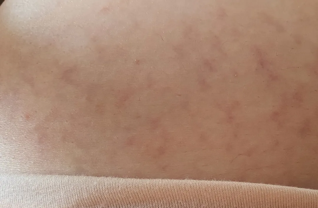 튼살이생겼어요.....충격 ㅜㅠㅠ