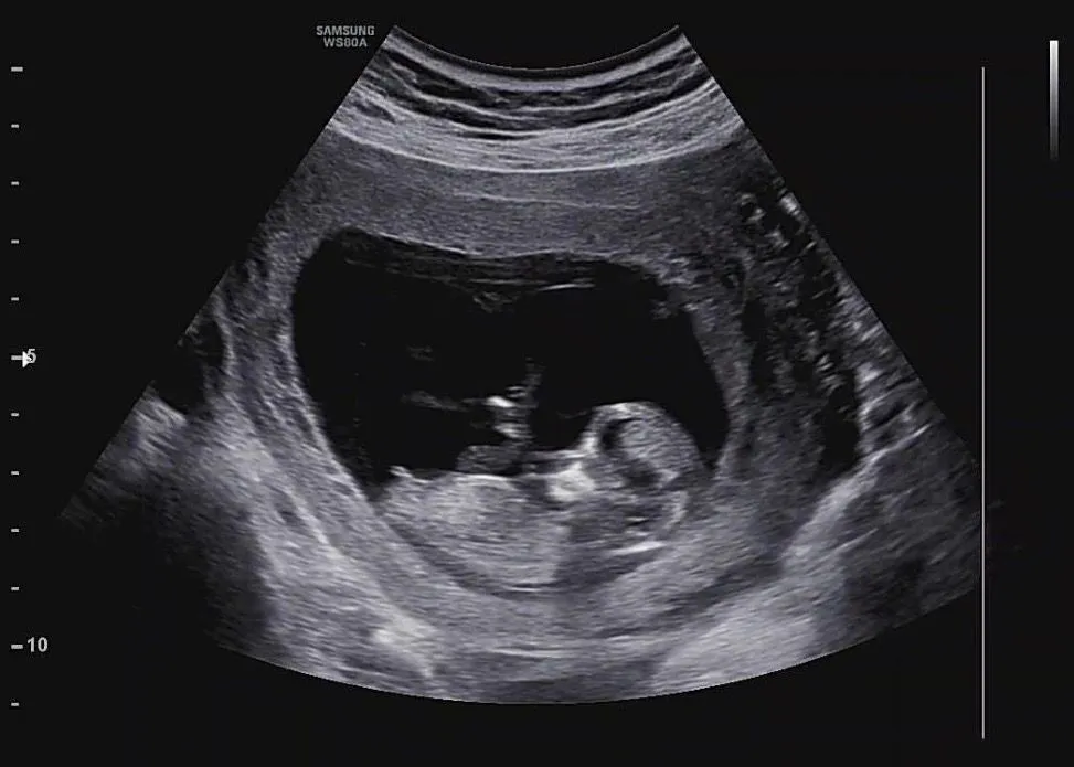 12주 2일 각도법 보일까용...? 2