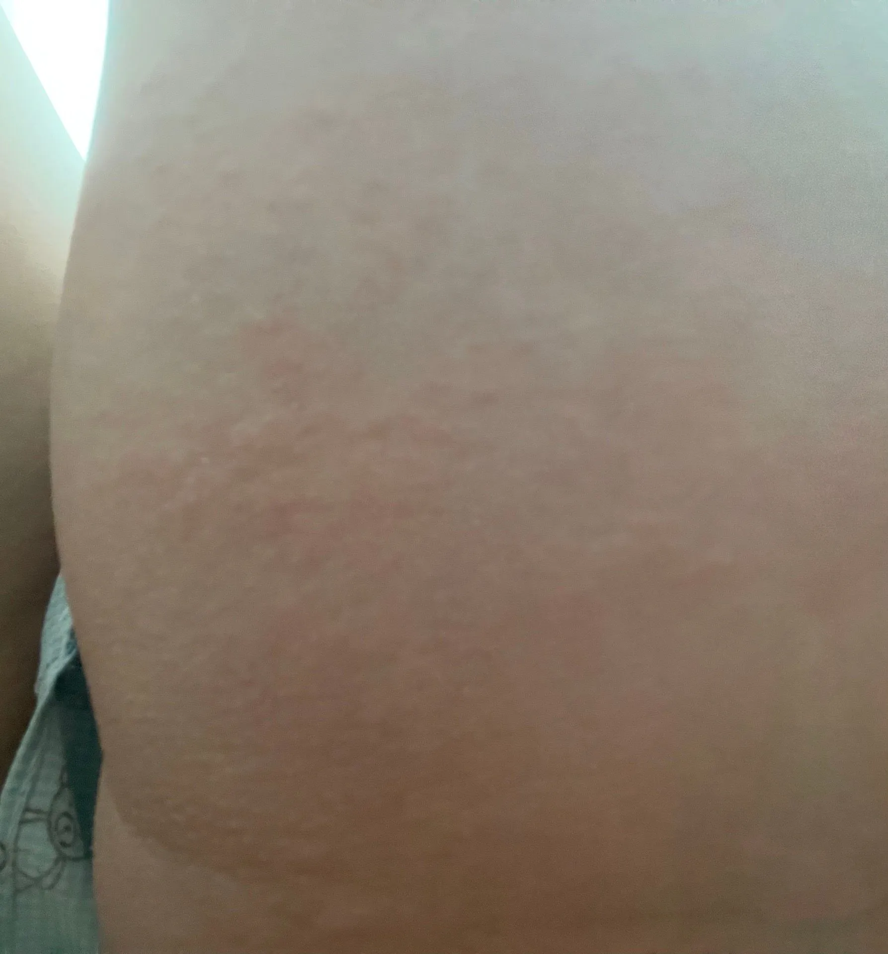 (사진) 두드러기 증상 3