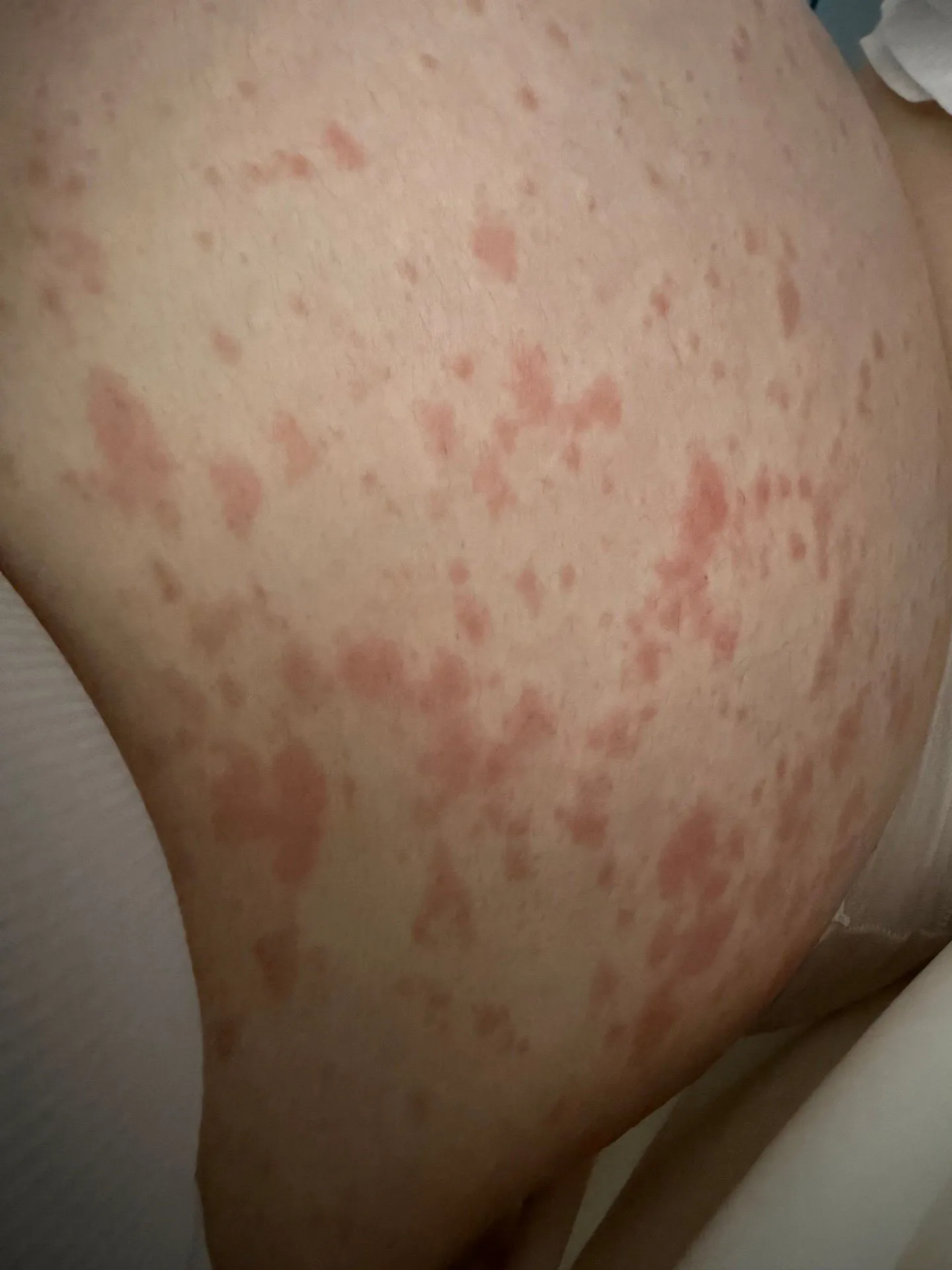 도와주세요 제발..임신소양증 극복하신 분들 ㅜㅜ 1