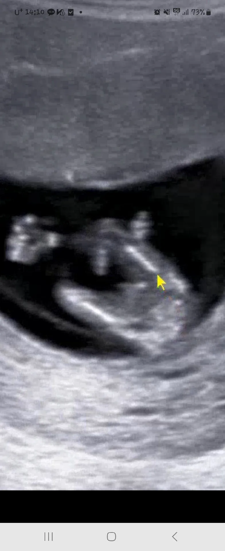 12주0일 성별이 뭘까용...?잘보시는분들 한번씩 봐주세요ㅜㅜ  3